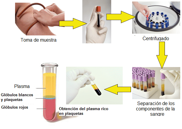 PRP plasma rico en plaquetas 6