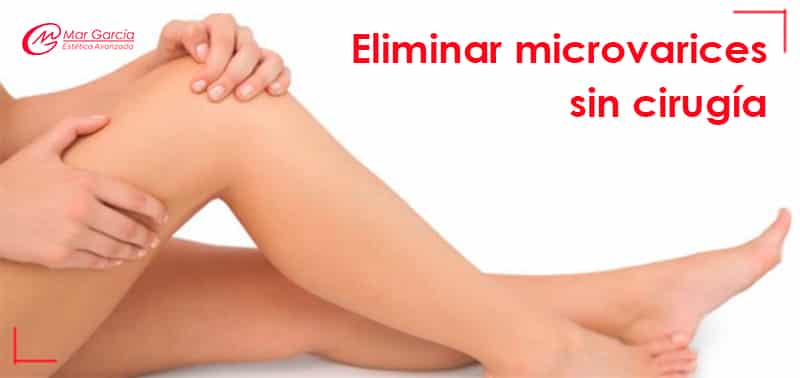 Eliminar microvarices sin cirugía