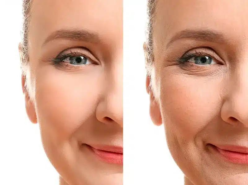 oxigenoterapia facial antes y despues