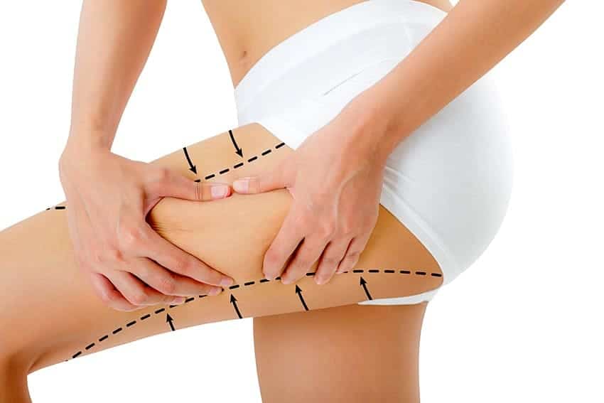 que es la mesoterapia corporal para la celulitis