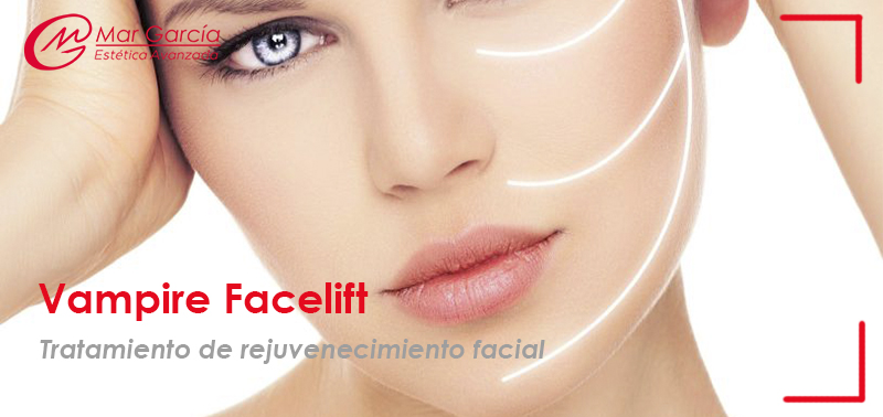 Vampire Facelift