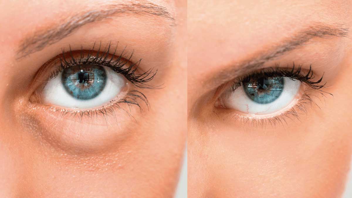 tratamientos bolsas ojos sin cirugia