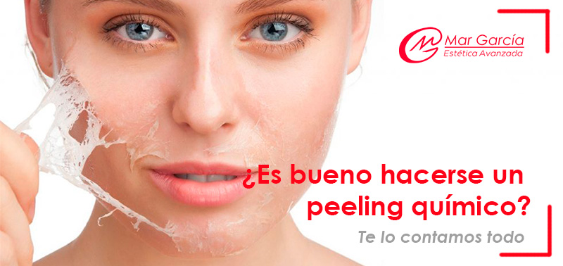 Es-bueno-hacerse-un-peeling-químico