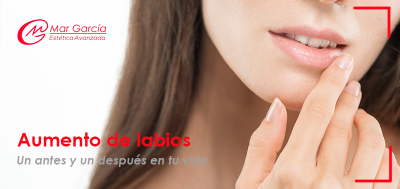 Aumento-de-labios-un-antes-y-un-después-en-tu-vida Aumento de labios
