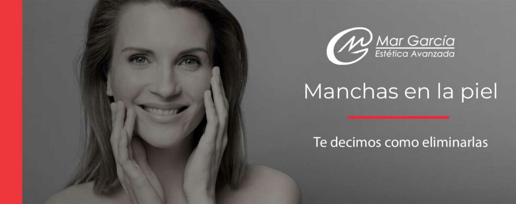 Manchas-en-la-piel