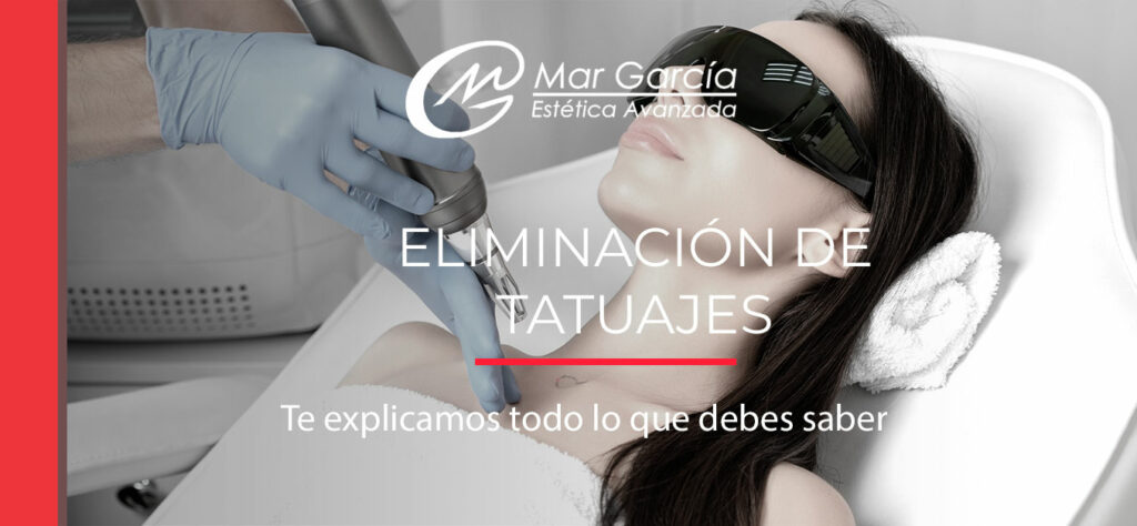 Eliminación-de-tatuajes