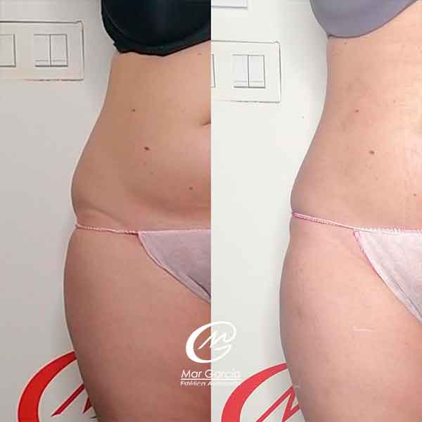 LIPOLASER ABDOMEN ANTES Y DESPUES MADRID