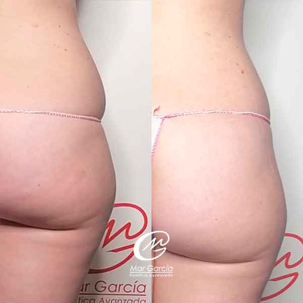 LIPOLASER GLUTEOS ANTES Y DESPUES MADRID