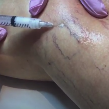 microespuma para varices antes y después