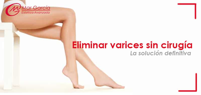 eliminar las varices