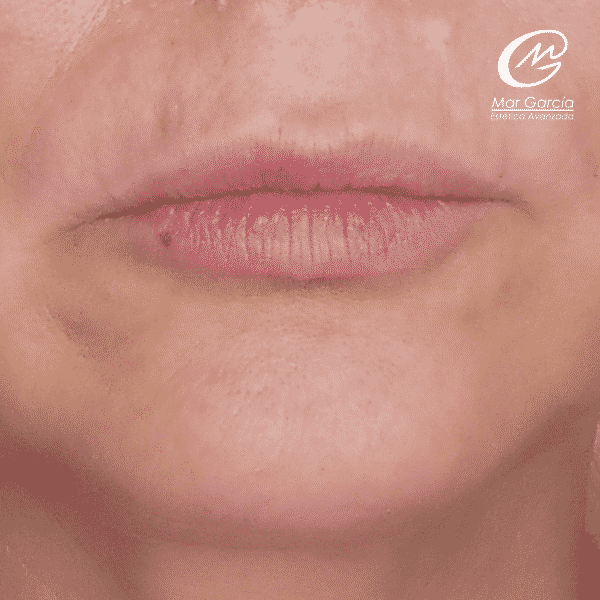 Antes Tratamiento Hidratación y Perfilado de Labios Mar García