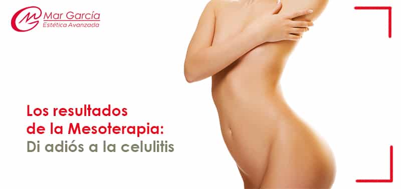 Mesoterapia