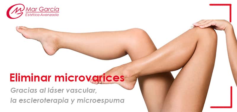 microvarices
