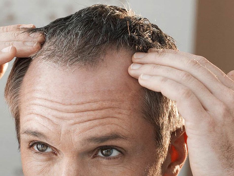 Qué es el Minoxidil y para qué sirve