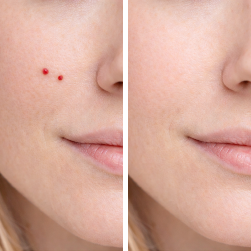 Eliminación de Angiomas