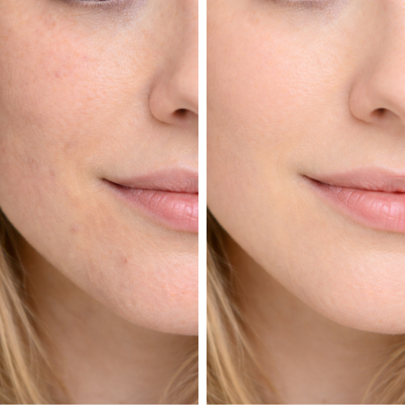 Peeling Químico Facial