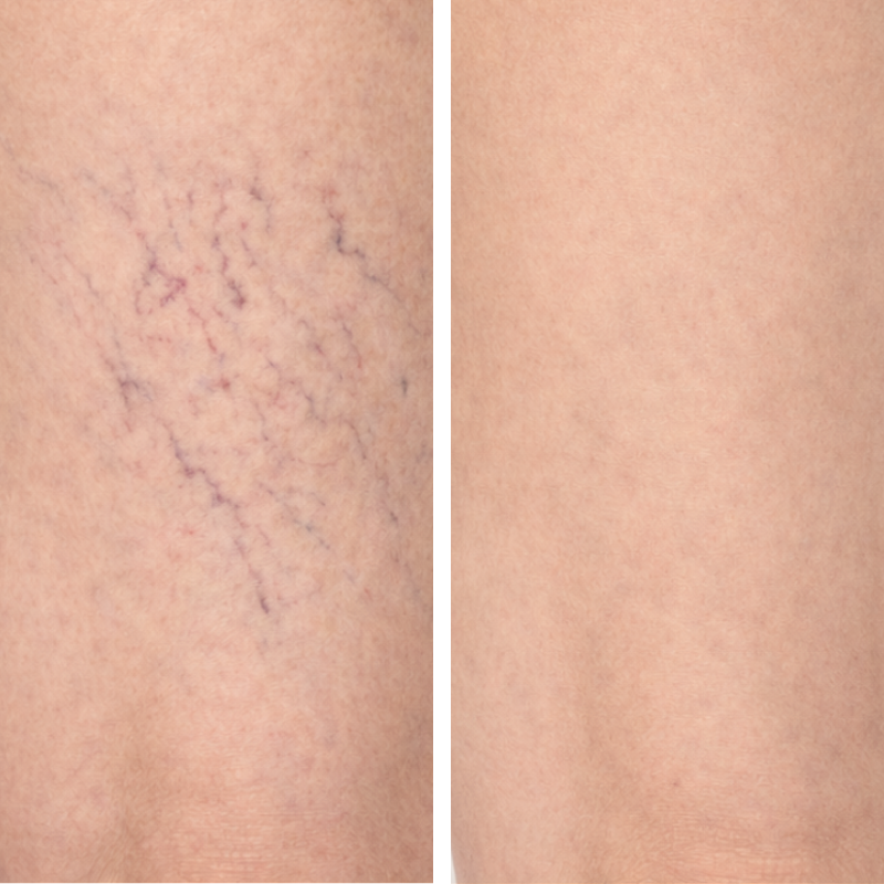 Escleroterapia