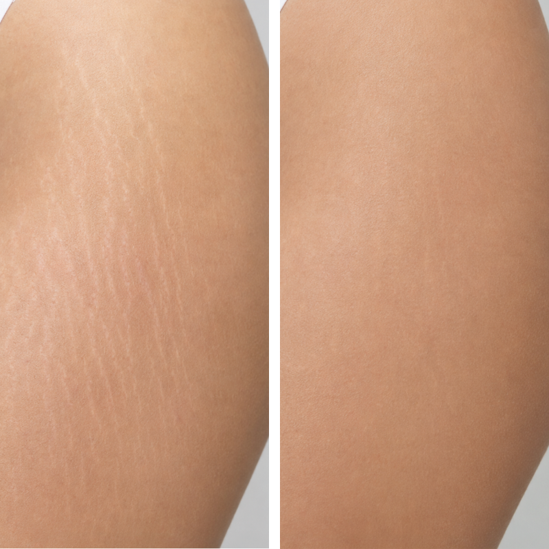Peeling químico corporal