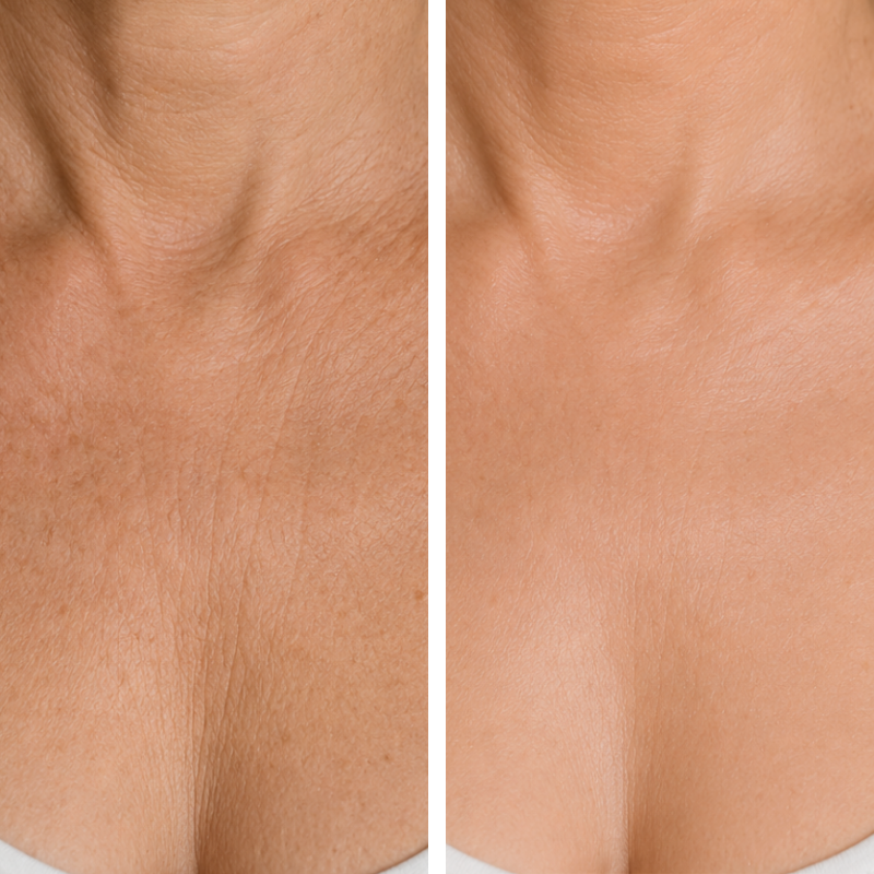 Dermapen en escote