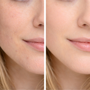 Peeling Químico Facial