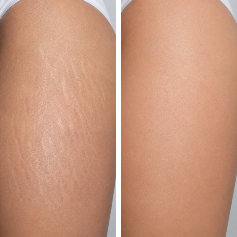 Dermapen microneedling